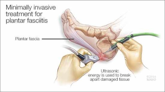 Are You Suffering From Plantar Fasciitis?