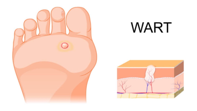 How To Get Rid Of Plantar Warts In Most Effective Ways  Skin