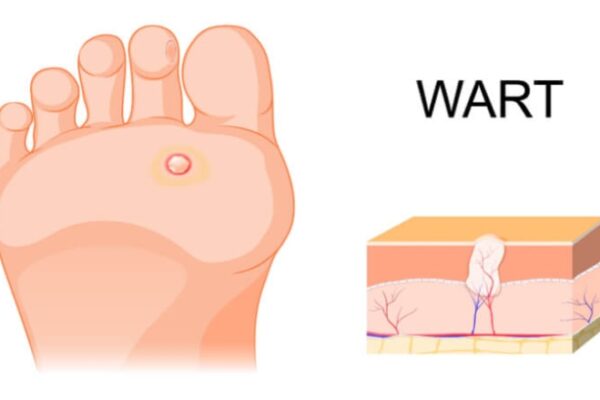 Sole Savior: Effortless Ways To Banish Plantar Warts For Good