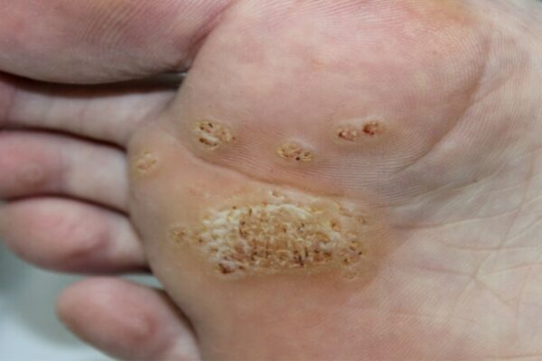 Swiftly Eliminate Plantar Warts With These Effective Methods