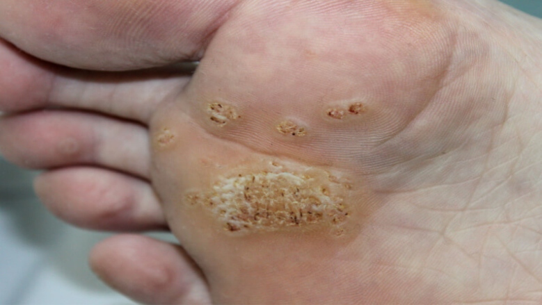 Swiftly Eliminate Plantar Warts With These Effective Methods