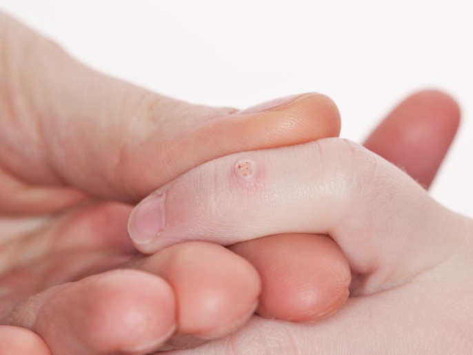 Handy Solutions: Say Goodbye To Plantar Warts On Your Hands For Good!