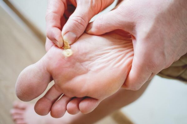 Home Remedies For Plantar Warts: Say Goodbye To Foot Woes!