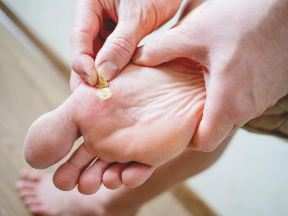 Home Remedies For Plantar Warts: Say Goodbye To Foot Woes!