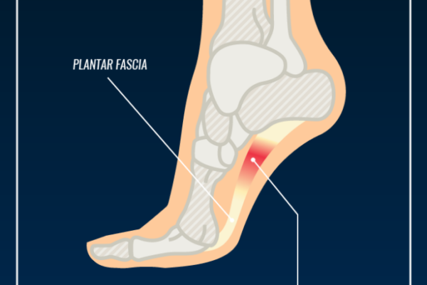 10 Quick & Effective Ways To Treat Plantar Fasciitis And Get Back On Your Feet Fast