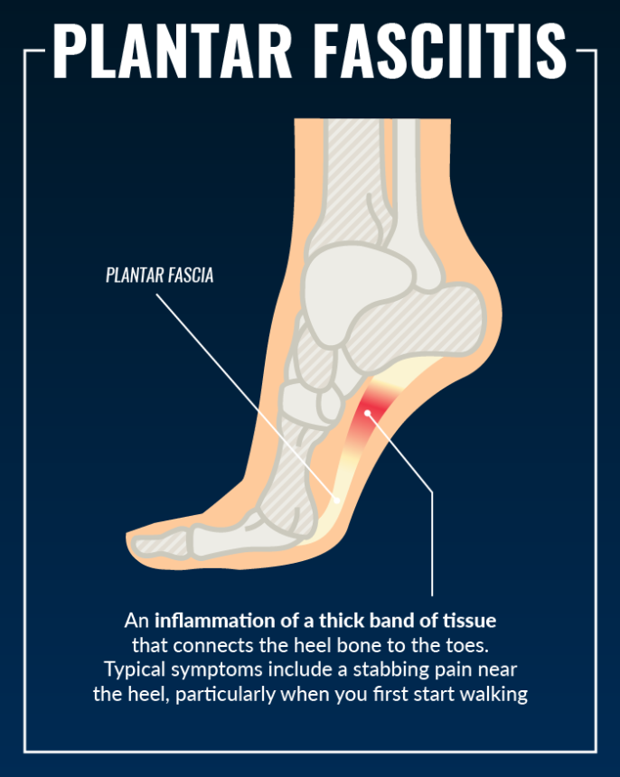 10 Quick & Effective Ways To Treat Plantar Fasciitis And Get Back On Your Feet Fast