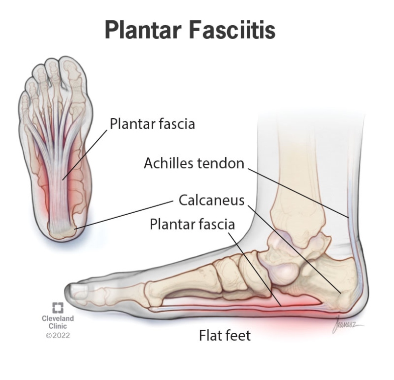 Plantar Fasciitis: Symptoms, Causes & Treatment Options