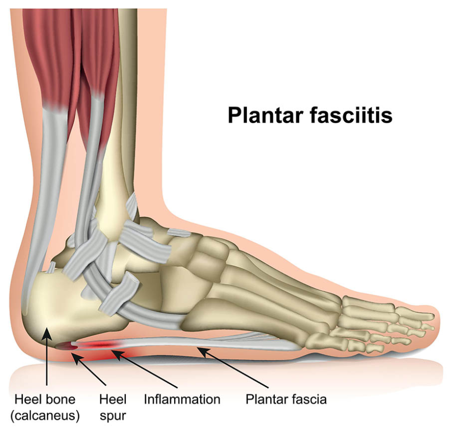 Unleash Your Feet: Innovative Ways To Banish Plantar Fasciitis For Good