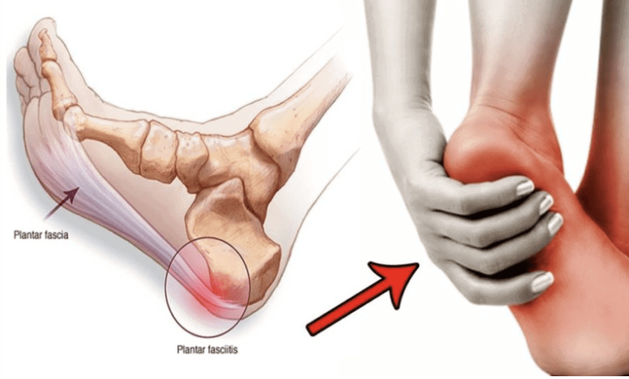 Say Goodbye To Plantar Fasciitis Pain Fast With These Proven Methods