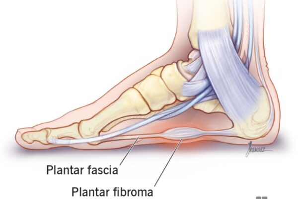 Say Goodbye To Plantar Fibroma: Effective Ways To Eliminate Foot Pain