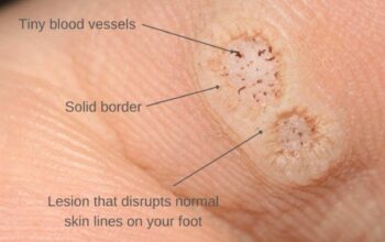 Banish Plantar Warts Quickly: Effective Remedies For Fast Relief