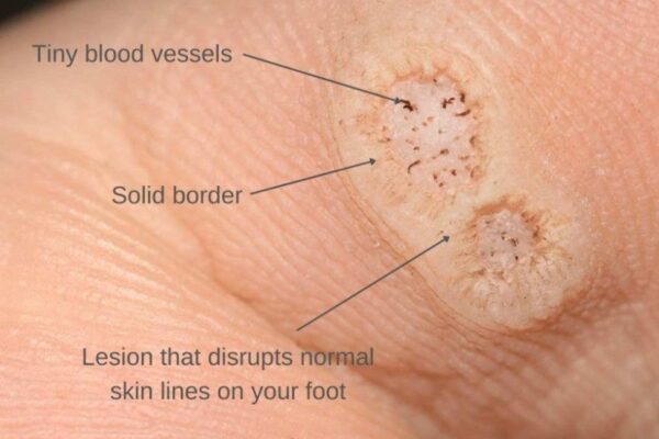 Banish Plantar Warts Quickly: Effective Remedies For Fast Relief