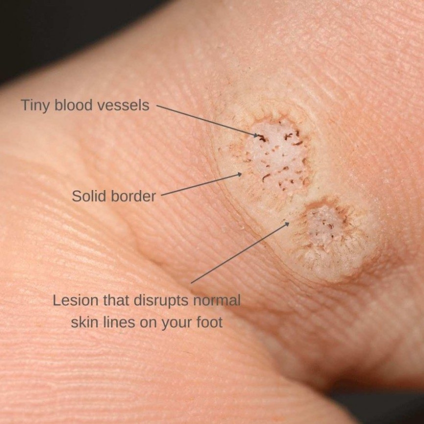 Finger-Lickin’ Good: Say Goodbye To Plantar Warts On Your Fingers For Good!