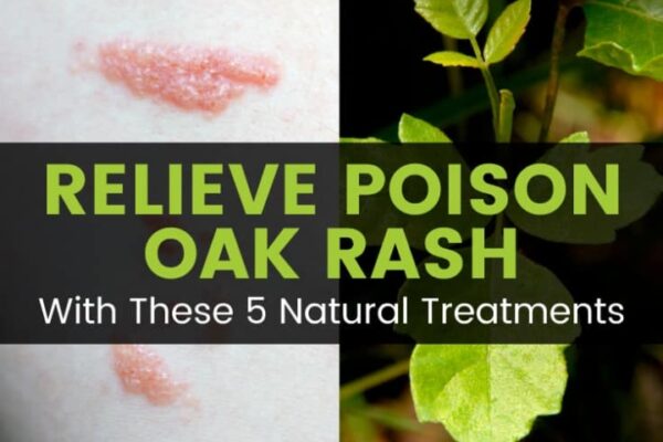 Banish Plant Rash For Good: Top Tips For Soothing Your Skin Naturally