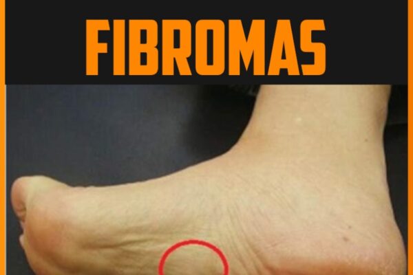 Say Goodbye To Plantar Fibromatosis: Effective Ways To Eliminate Foot Lumps