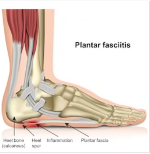 Run Pain-Free: Effective Ways To Eliminate Plantar Fasciitis For Good