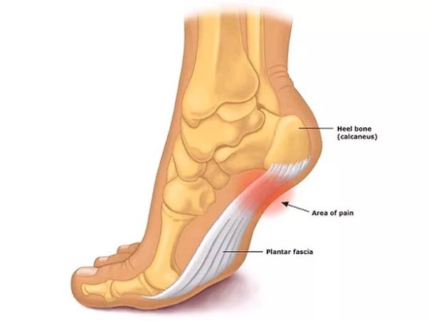 Kick Plantar Fasciitis To The Curb For Good With These Game-changing Tips!